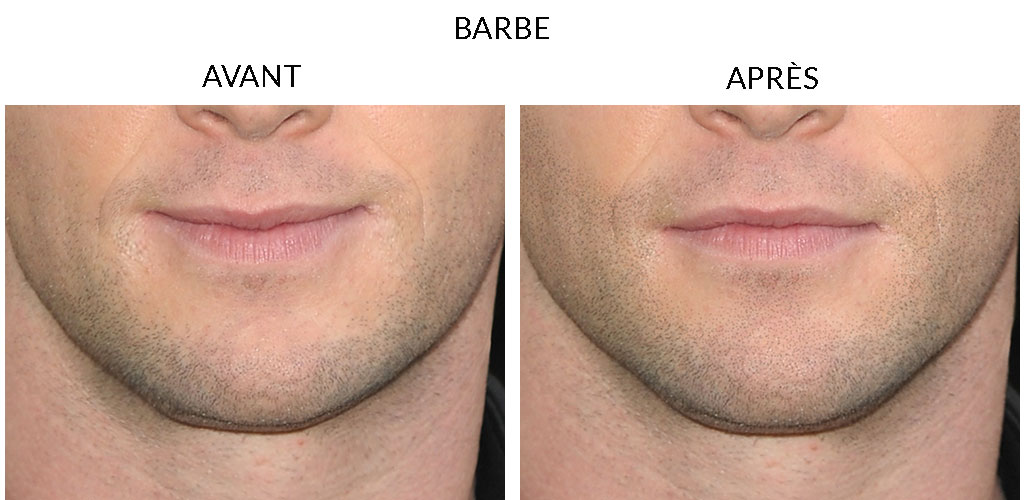 MicropigmentationCapillaire_Barbe