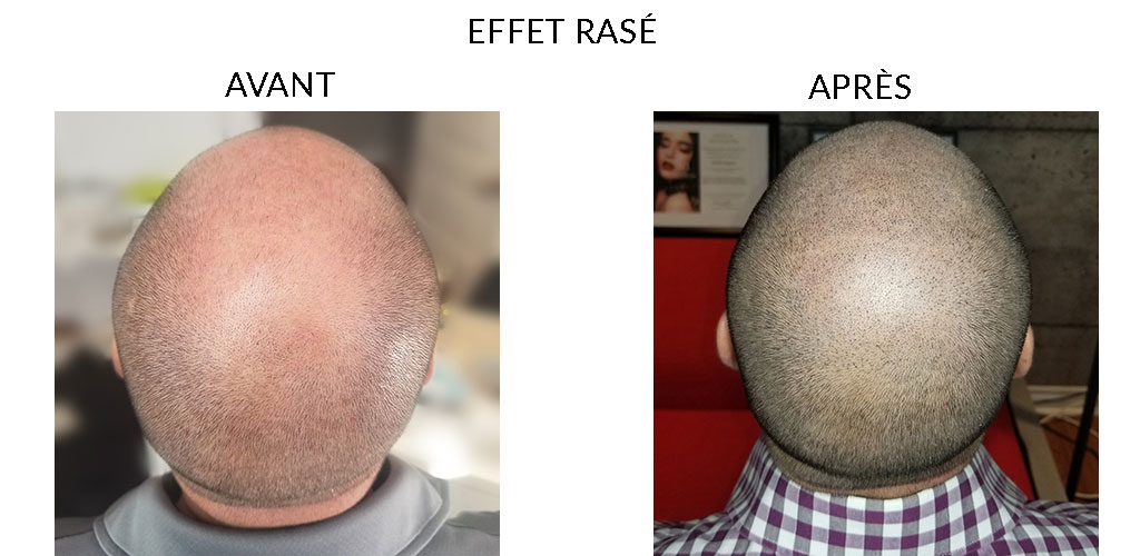 MicropigmentationCapillaire_EffetRase